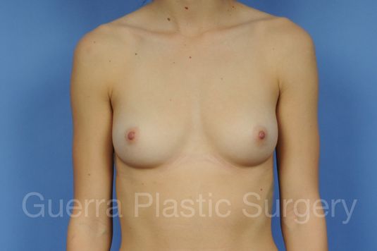 Case #1001094 Before