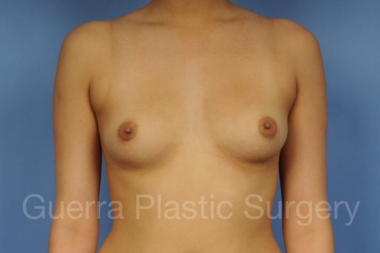 Case #1001095 Before