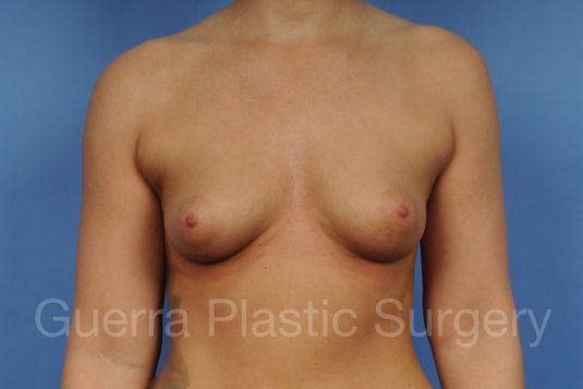 Case #1001096 Before