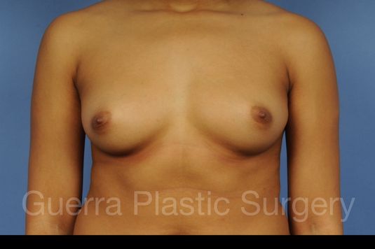 Case #1001097 Before