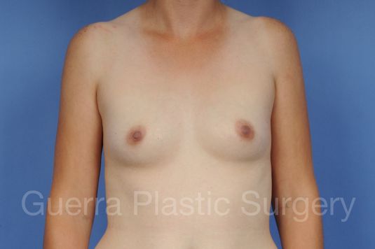 Case #1001100 Before