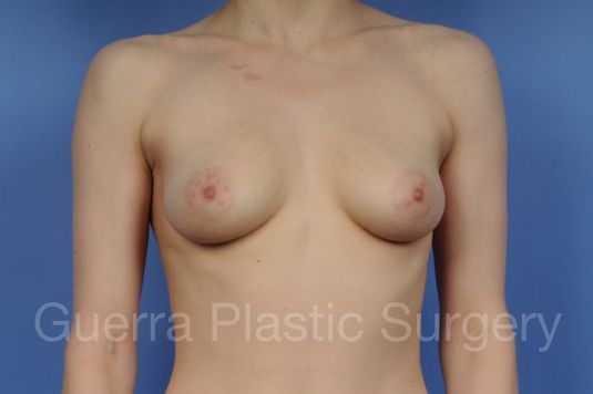 Case #1001102 Before