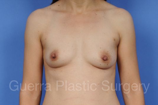 Case #1001109 Before