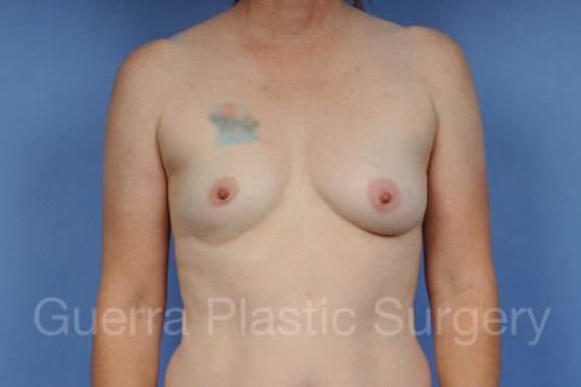 Case #1001110 Before