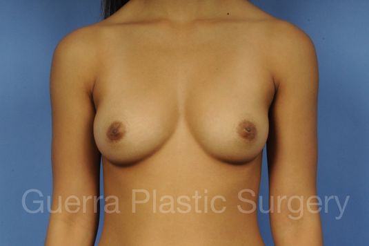 Case #1001111 Before