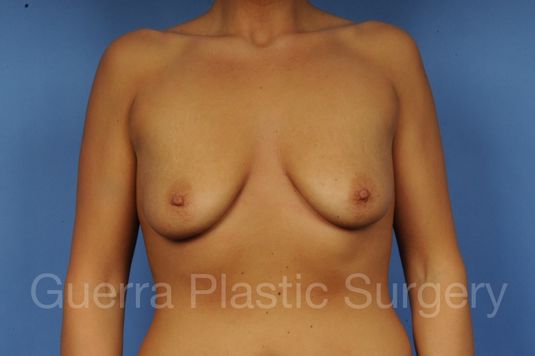 Case #1001112 Before