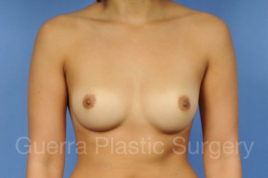 Case #1001114 Before