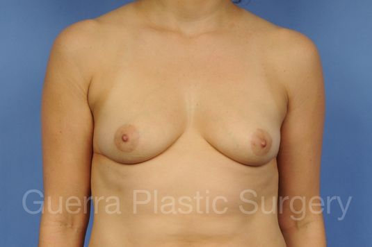 Case #1001115 Before