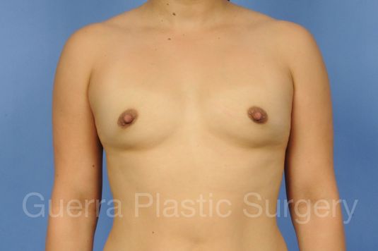 Case #1001116 Before