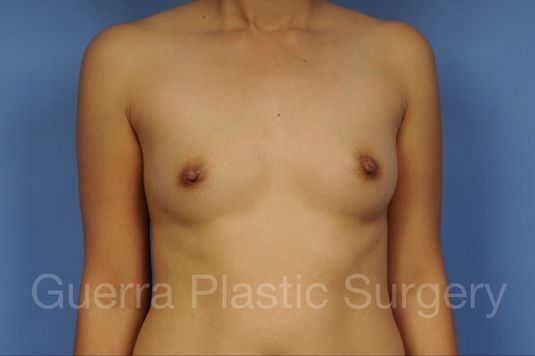 Case #1001117 Before