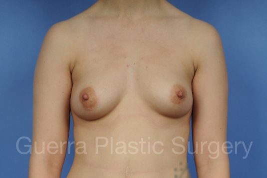 Case #1001119 Before