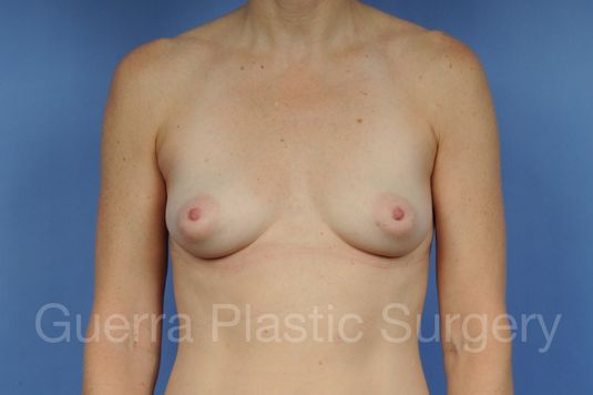 Case #1001122 Before