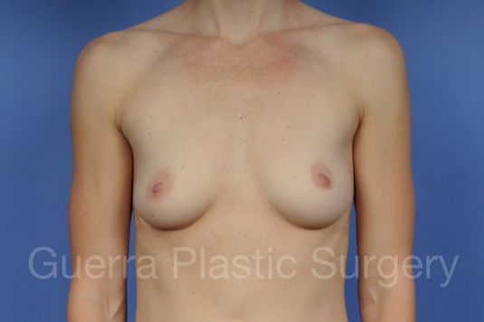 Case #1001126 Before