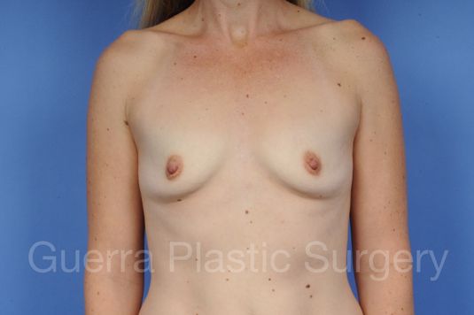 Case #1001127 Before