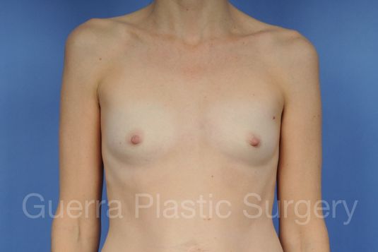 Case #1001131 Before