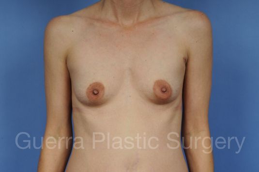 Case #1001132 Before