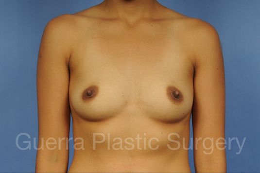 Case #1001133 Before