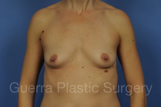 Case #1001134 Before