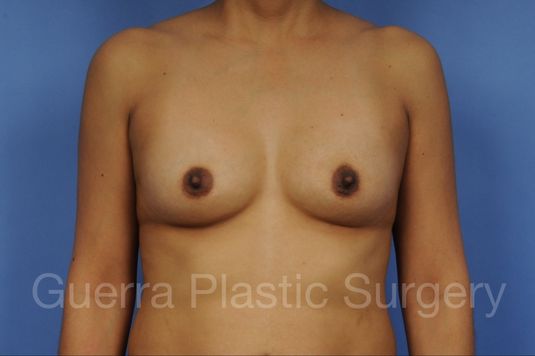 Case #1001135 Before