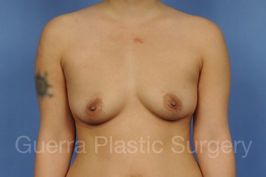 Case #1001137 Before