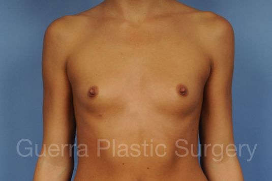 Case #1001138 Before