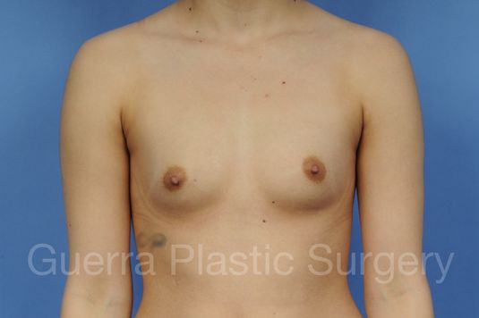 Case #1001139 Before