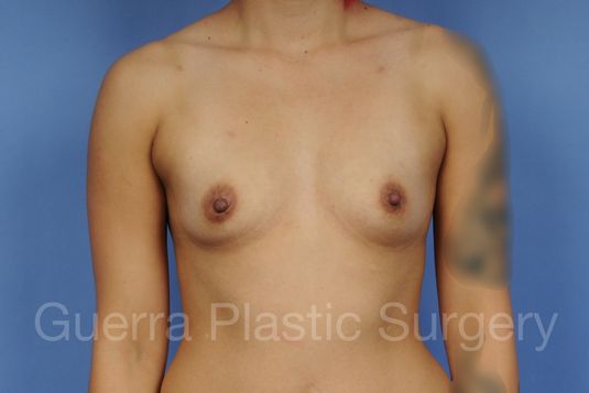 Case #1001140 Before