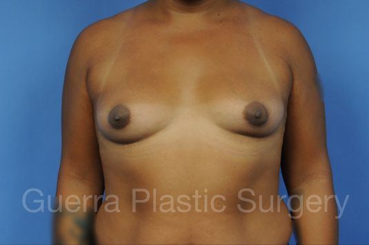 Case #1001142 Before