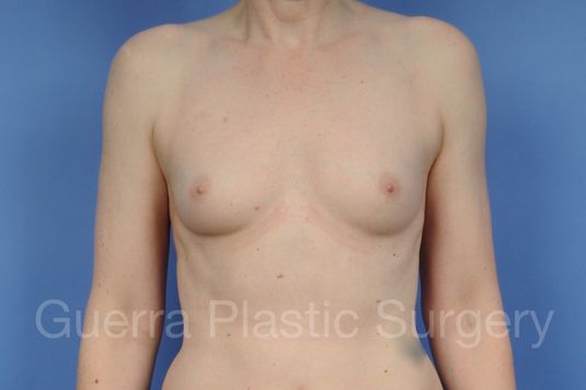 Case #1002042 Before