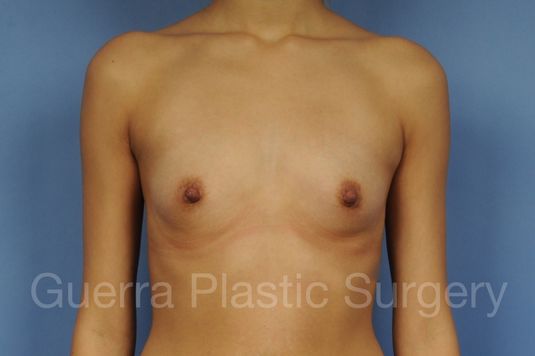 Case #1002044 Before