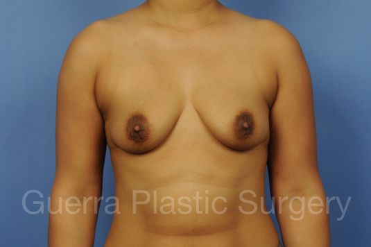 Case #1002045 Before