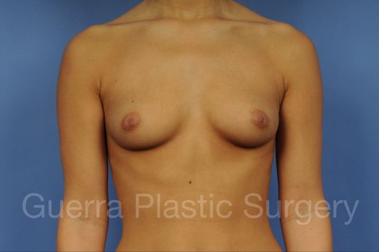 Case #1001144 Before