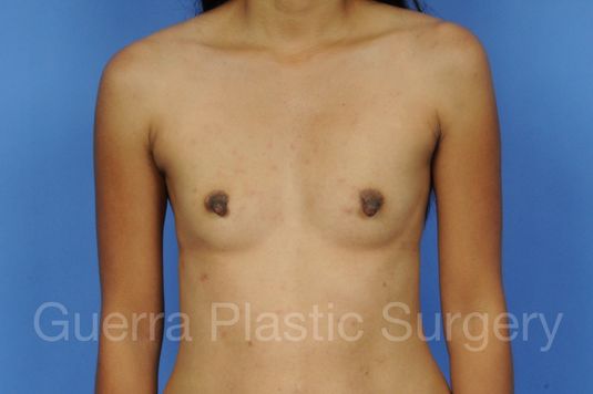 Case #1001146 Before