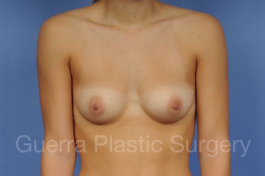 Case #1001147 Before