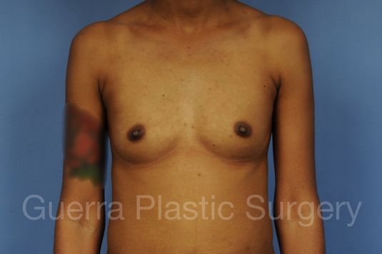 Case #1001148 Before