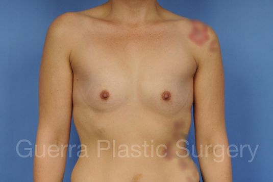 Case #1001149 Before