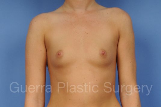 Case #1001151 Before