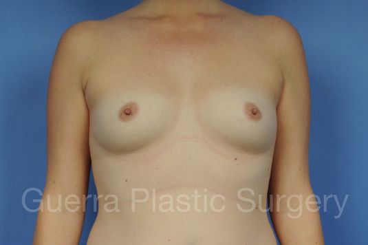 Case #1001153 Before