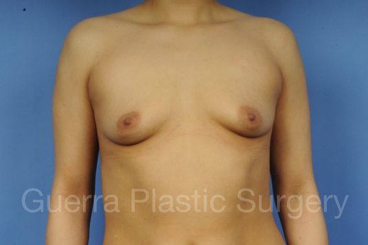 Case #1001154 Before