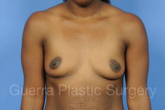 Case #1001155 Before