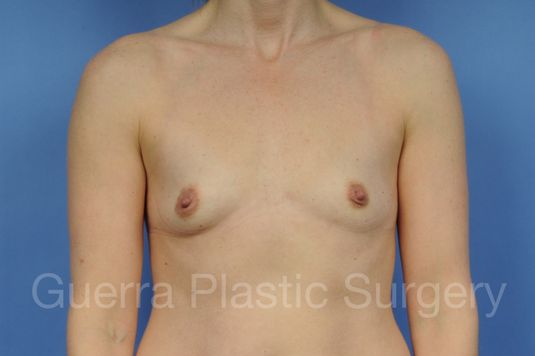 Case #1001156 Before