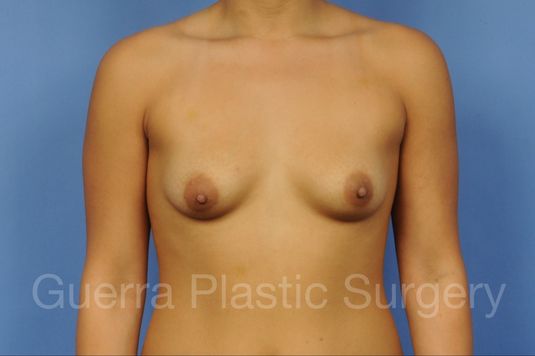 Case #1001158 Before