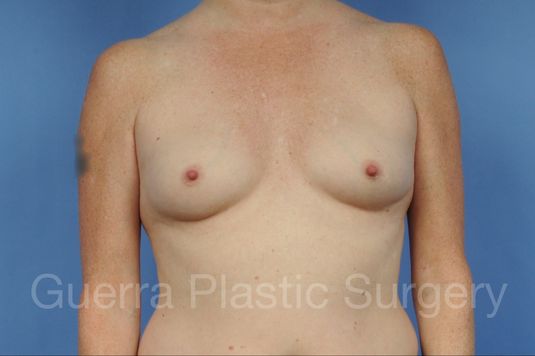 Case #1001163 Before