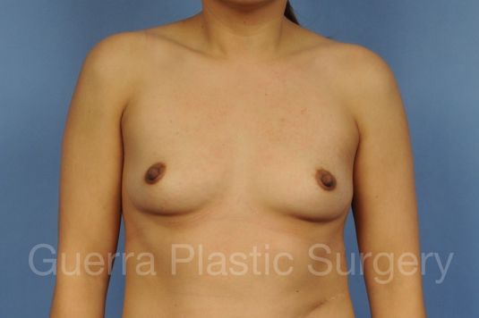 Case #1001164 Before