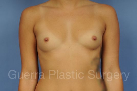 Case #1001165 Before