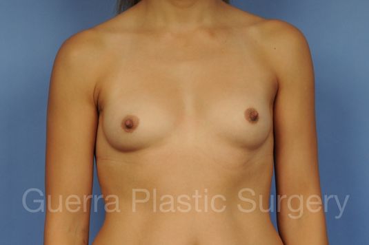 Case #1001166 Before