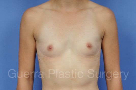 Case #1001167 Before