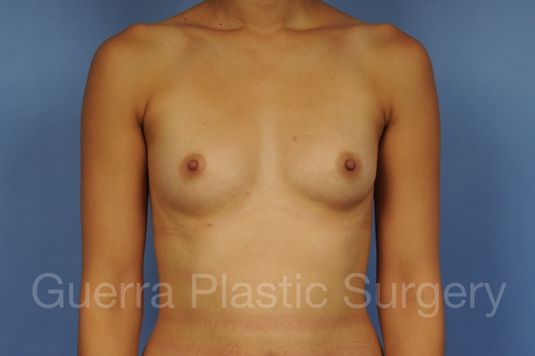 Case #1001168 Before