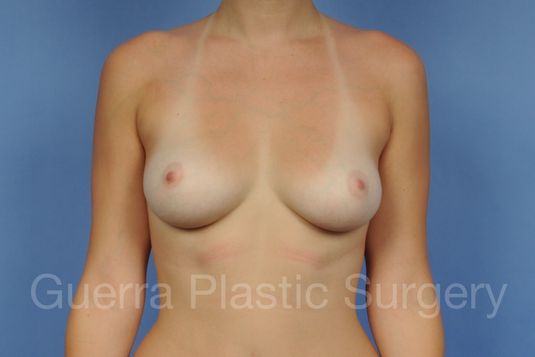 Case #1001169 Before