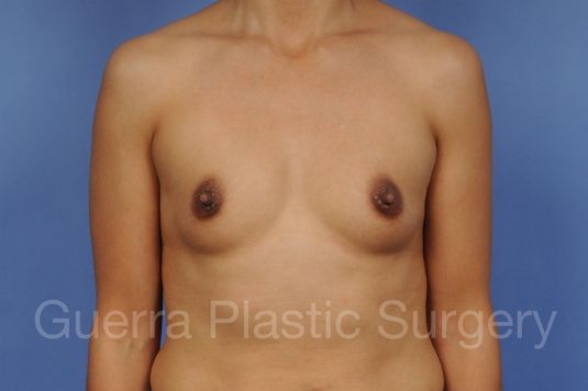 Case #1001170 Before